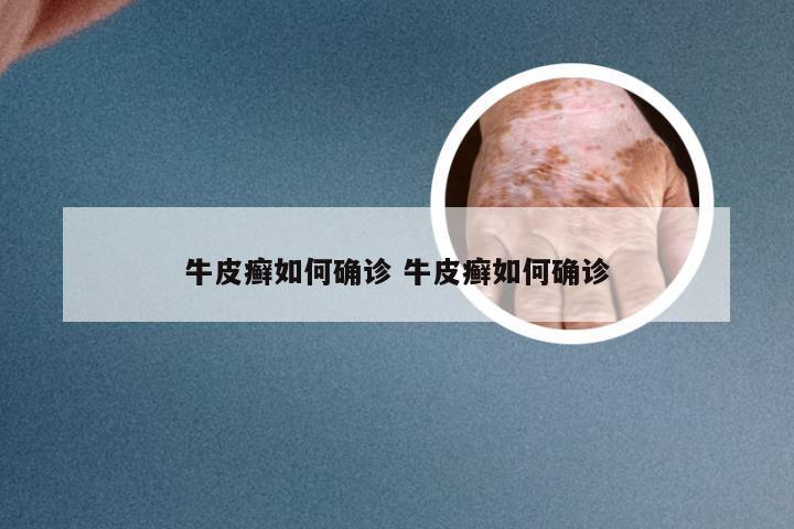 牛皮癣如何确诊 牛皮癣如何确诊