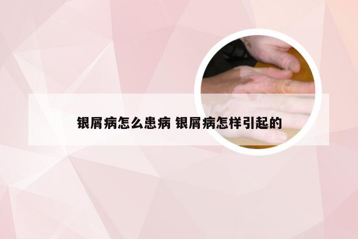 银屑病怎么患病 银屑病怎样引起的