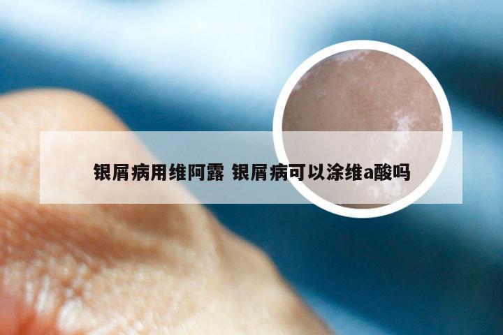 银屑病用维阿露 银屑病可以涂维a酸吗