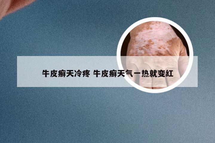 牛皮癣天冷疼 牛皮癣天气一热就变红
