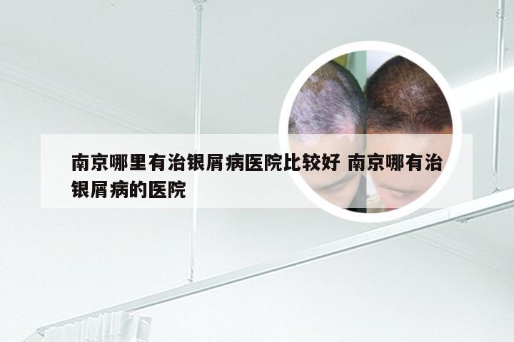 南京哪里有治银屑病医院比较好 南京哪有治银屑病的医院