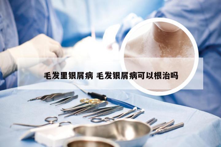 毛发里银屑病 毛发银屑病可以根治吗