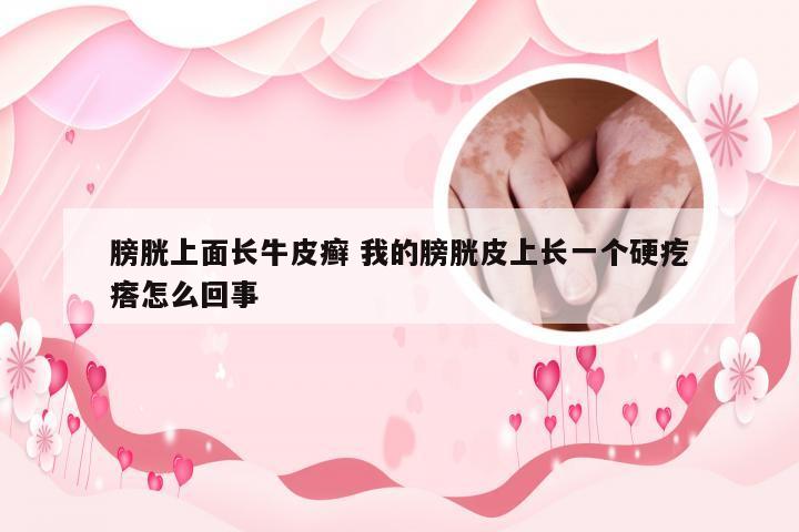 膀胱上面长牛皮癣 我的膀胱皮上长一个硬疙瘩怎么回事