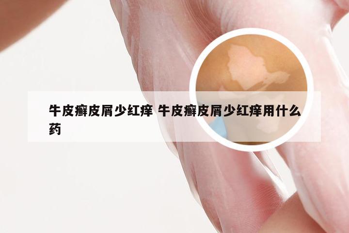 牛皮癣皮屑少红痒 牛皮癣皮屑少红痒用什么药