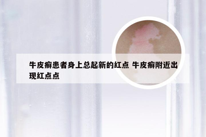 牛皮癣患者身上总起新的红点 牛皮癣附近出现红点点