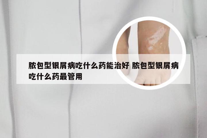 脓包型银屑病吃什么药能治好 脓包型银屑病吃什么药最管用