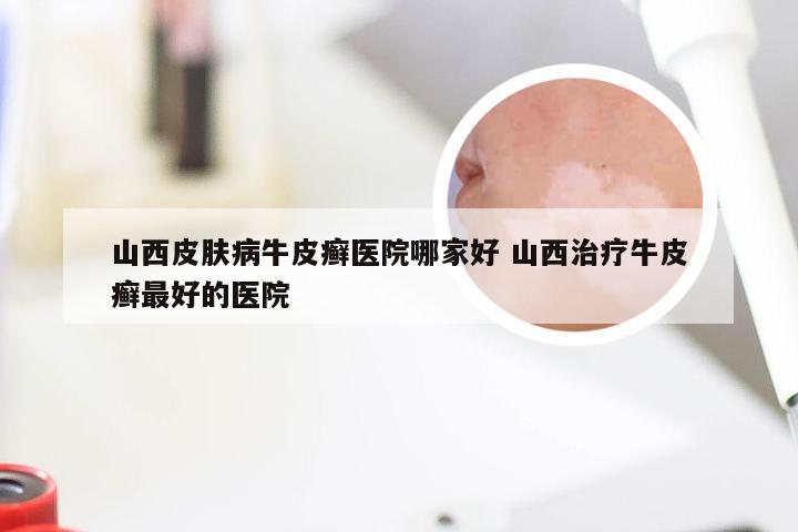 山西皮肤病牛皮癣医院哪家好 山西治疗牛皮癣最好的医院