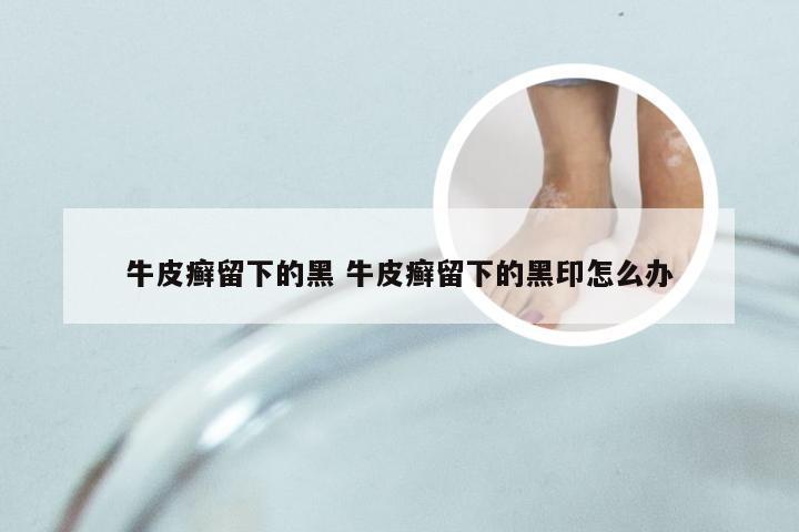 牛皮癣留下的黑 牛皮癣留下的黑印怎么办