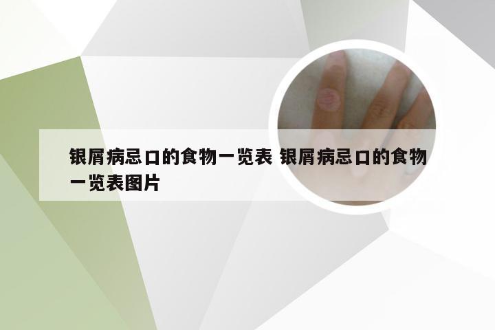 银屑病忌口的食物一览表 银屑病忌口的食物一览表图片