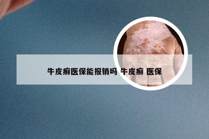 牛皮癣医保能报销吗 牛皮癣 医保