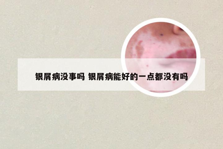 银屑病没事吗 银屑病能好的一点都没有吗