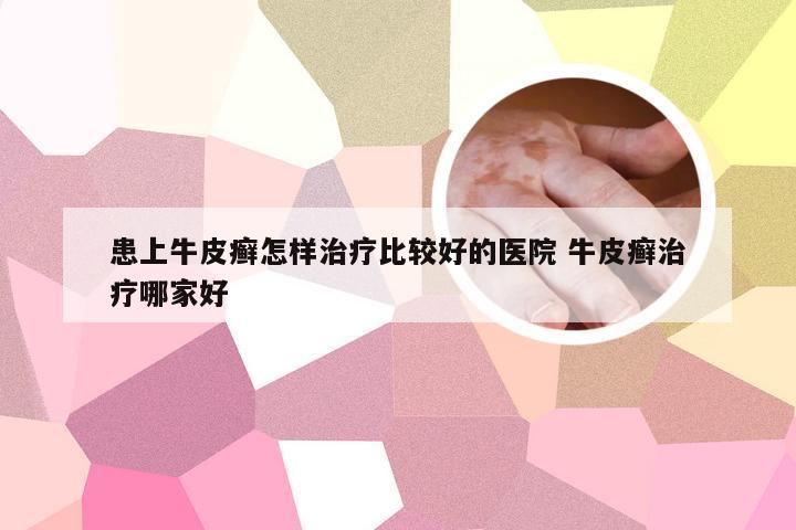 患上牛皮癣怎样治疗比较好的医院 牛皮癣治疗哪家好
