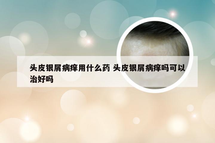 头皮银屑病痒用什么药 头皮银屑病痒吗可以治好吗