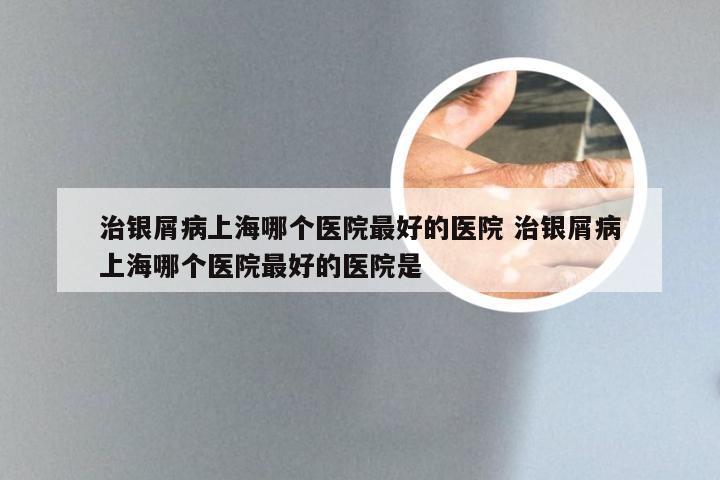 治银屑病上海哪个医院最好的医院 治银屑病上海哪个医院最好的医院是