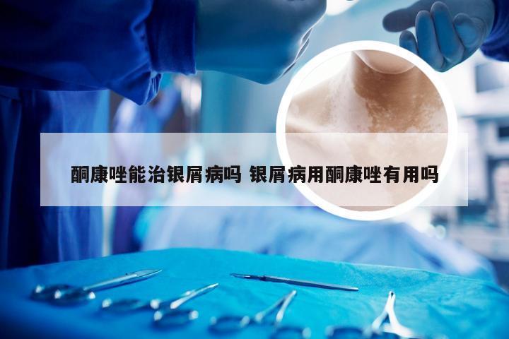 酮康唑能治银屑病吗 银屑病用酮康唑有用吗