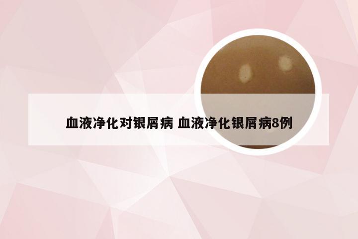 血液净化对银屑病 血液净化银屑病8例