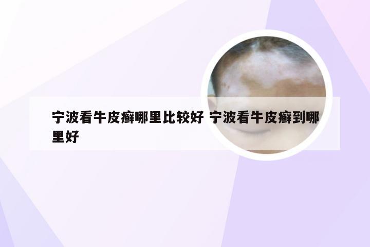 宁波看牛皮癣哪里比较好 宁波看牛皮癣到哪里好