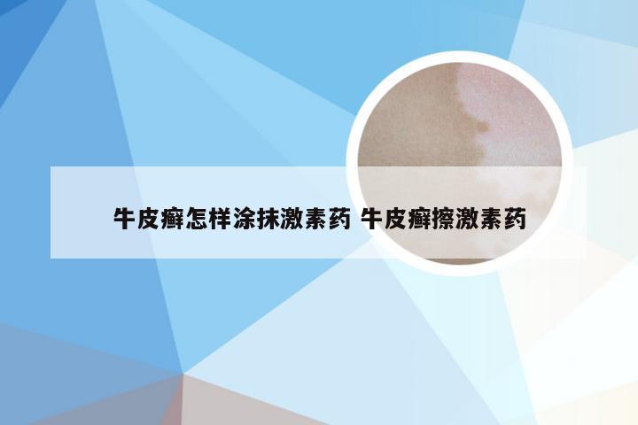 牛皮癣怎样涂抹激素药 牛皮癣擦激素药
