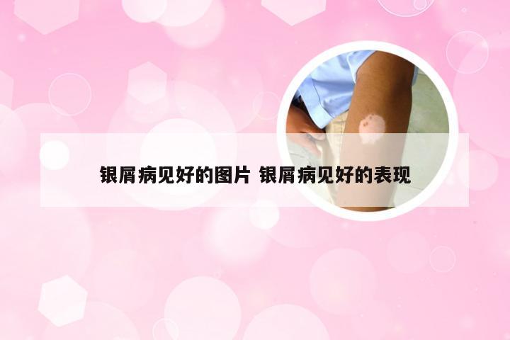 银屑病见好的图片 银屑病见好的表现