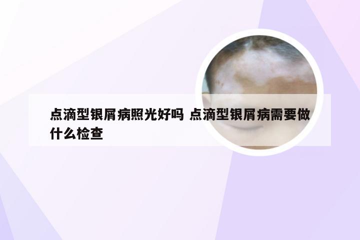点滴型银屑病照光好吗 点滴型银屑病需要做什么检查