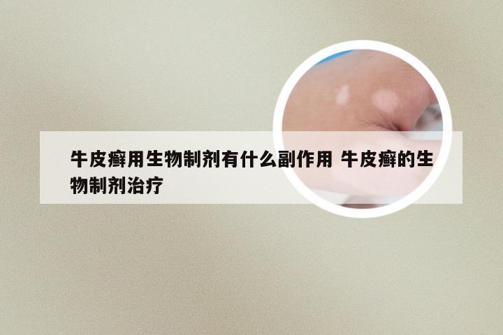 牛皮癣用生物制剂有什么副作用 牛皮癣的生物制剂治疗