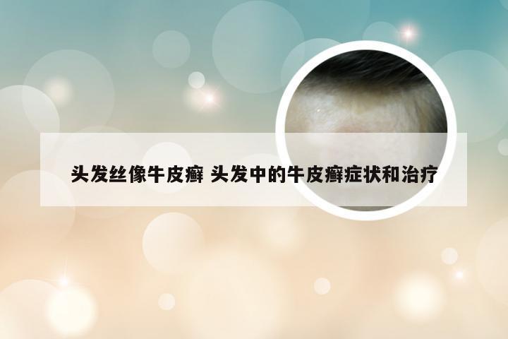 头发丝像牛皮癣 头发中的牛皮癣症状和治疗
