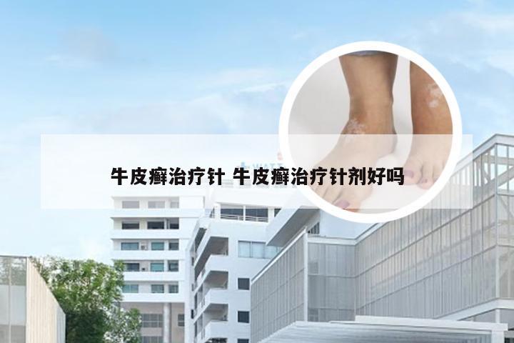 牛皮癣治疗针 牛皮癣治疗针剂好吗