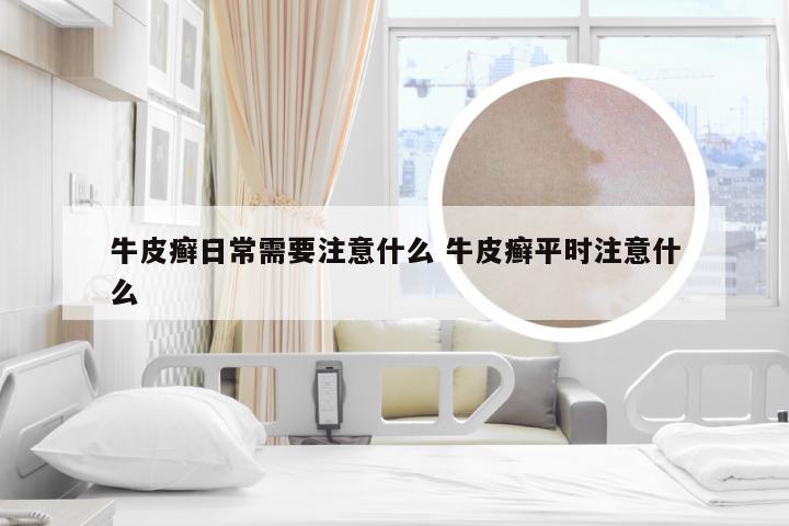 牛皮癣日常需要注意什么 牛皮癣平时注意什么