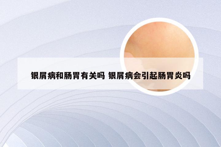 银屑病和肠胃有关吗 银屑病会引起肠胃炎吗