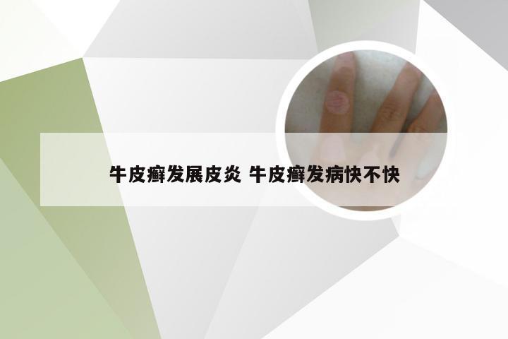 牛皮癣发展皮炎 牛皮癣发病快不快
