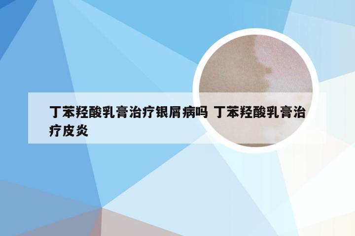 丁苯羟酸乳膏治疗银屑病吗 丁苯羟酸乳膏治疗皮炎