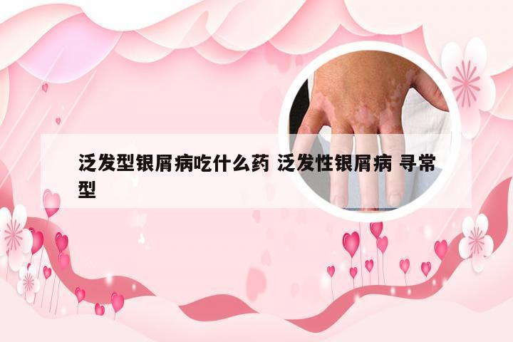 泛发型银屑病吃什么药 泛发性银屑病 寻常型