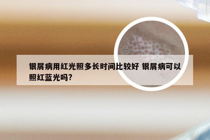 银屑病用红光照多长时间比较好 银屑病可以照红蓝光吗?