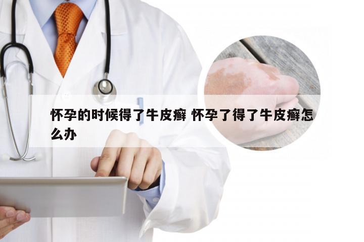 怀孕的时候得了牛皮癣 怀孕了得了牛皮癣怎么办