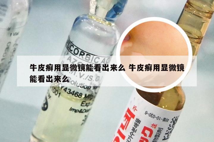 牛皮癣用显微镜能看出来么 牛皮癣用显微镜能看出来么
