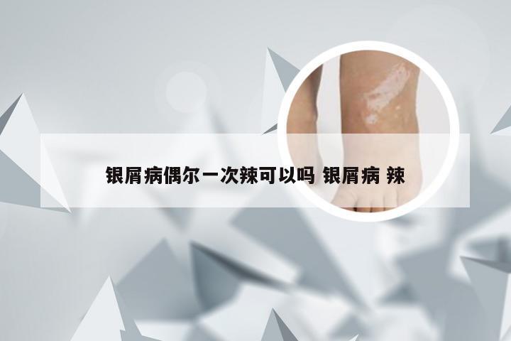 银屑病偶尔一次辣可以吗 银屑病 辣