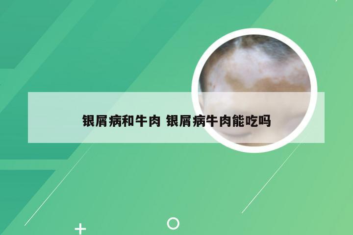 银屑病和牛肉 银屑病牛肉能吃吗