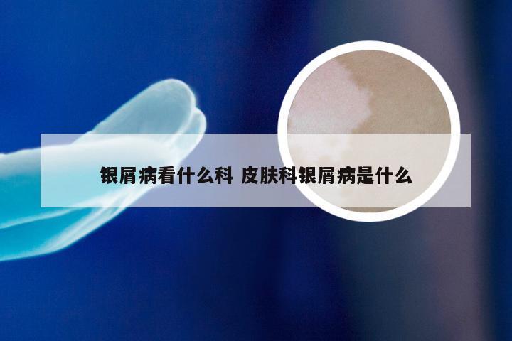 银屑病看什么科 皮肤科银屑病是什么