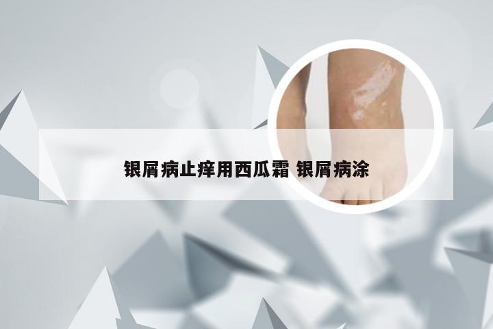 银屑病止痒用西瓜霜 银屑病涂