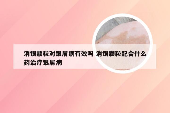 消银颗粒对银屑病有效吗 消银颗粒配合什么药治疗银屑病