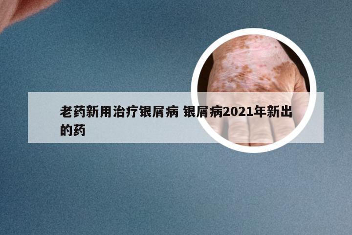老药新用治疗银屑病 银屑病2021年新出的药