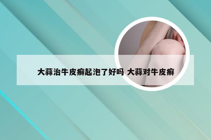 大蒜治牛皮癣起泡了好吗 大蒜对牛皮癣