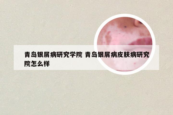 青岛银屑病研究学院 青岛银屑病皮肤病研究院怎么样