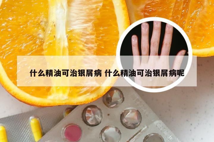 什么精油可治银屑病 什么精油可治银屑病呢