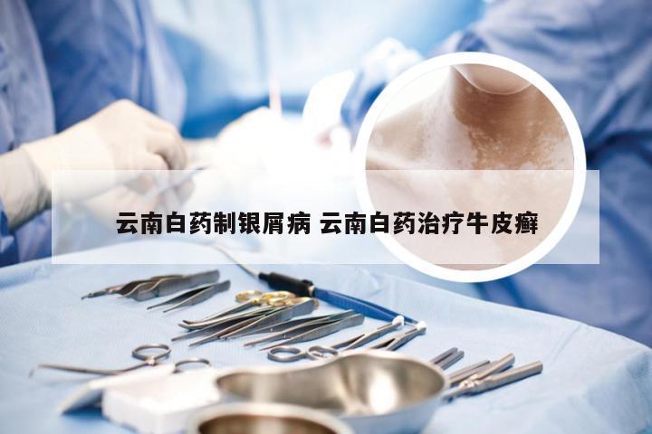 云南白药制银屑病 云南白药治疗牛皮癣
