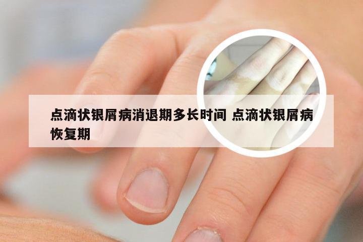 点滴状银屑病消退期多长时间 点滴状银屑病恢复期