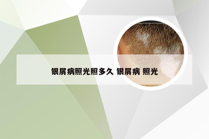 银屑病照光照多久 银屑病 照光