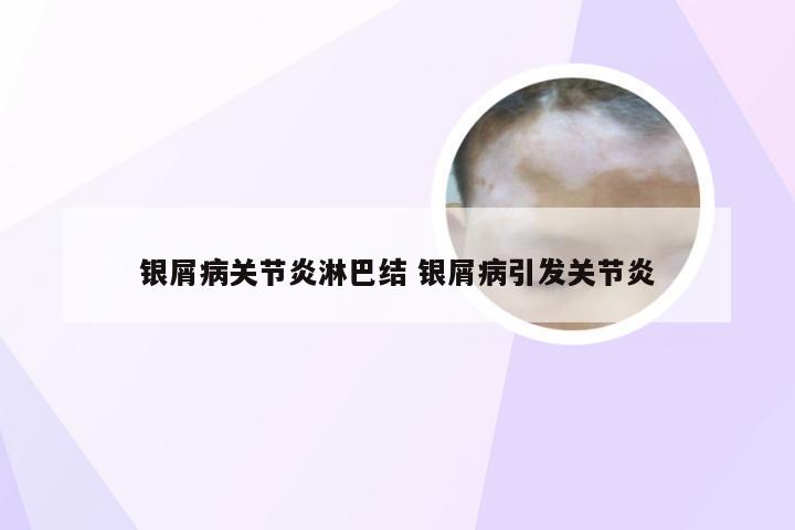 银屑病关节炎淋巴结 银屑病引发关节炎