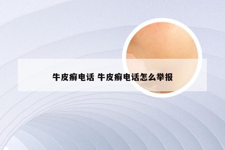 牛皮癣电话 牛皮癣电话怎么举报