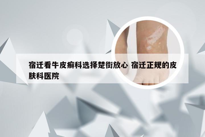 宿迁看牛皮癣科选择楚街放心 宿迁正规的皮肤科医院